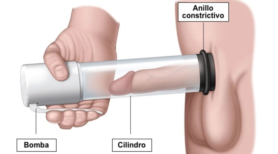 Cómo funcionan las bombas de succión de pene